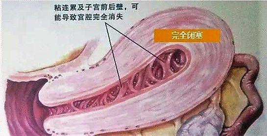 香港老牌的验血机构,宫腔粘连难好孕，收好这些备孕知识吧