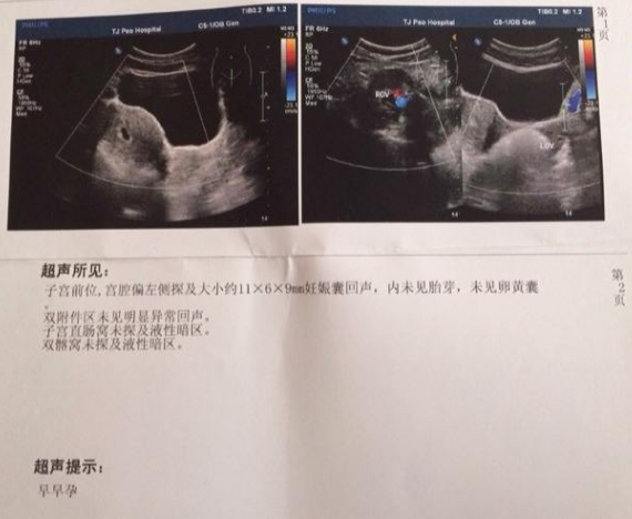 朋友怀孕6周去香港验血是男孩,AMH值0.09有自然怀孕的可能性吗，做试管有希望吗