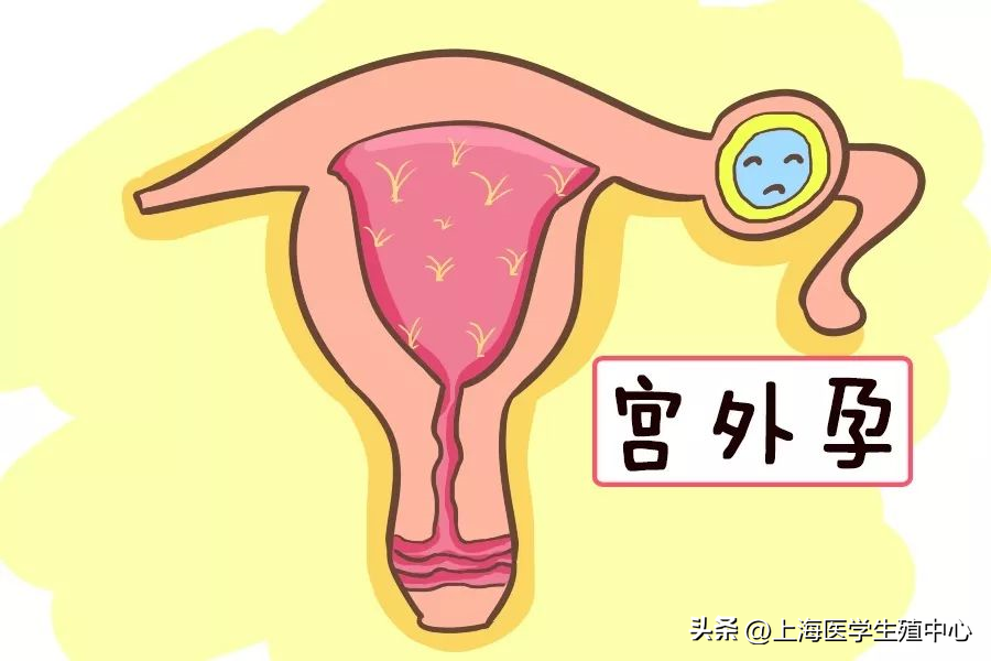 香港验血检验女孩,试管婴儿能不能避免宫外孕？不管是自然怀孕还是做试管，